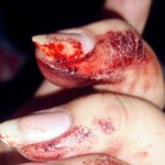 Wrist cut by blunt object