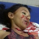 Slashed young girl