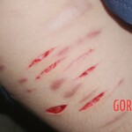 Teen girl self-harm