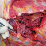 Detailed autopsy of Chinese woman