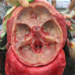 Detailed autopsy of Chinese woman