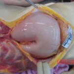 Autopsy of young woman