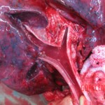 Autopsy of young woman