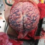 Autopsy of young woman