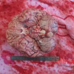 Autopsy of young woman