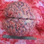 Autopsy of young woman