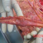 Autopsy of young woman