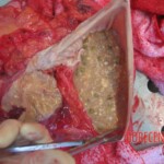 Autopsy of young woman