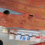 Autopsy of young woman