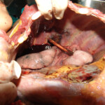 Brutally raped pregnant Chinese woman in morgue