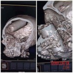 Demostrant hit by tear grenade to the head