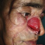 Face torn by himalayan black bear