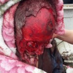 Face eaten by pitbulls