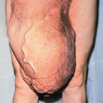 Large right inguinal hernia