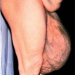 Large right inguinal hernia