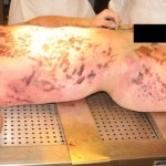 Suicide by skydiving