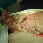 Necrosis of testicles