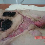 Necrosis of testicles