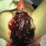 Necrosis of testicles