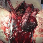 Necrosis of testicles