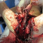 Necrosis of testicles