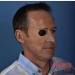 Surgical face reconstruction