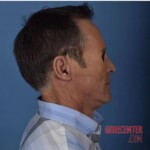 Surgical face reconstruction