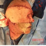 Surgical face reconstruction