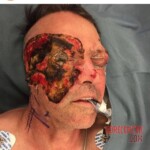 Surgical face reconstruction