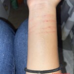 Teen girl self-harm