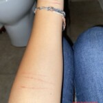Teen girl self-harm