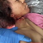 Slashed thai woman