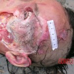 Dead young girl in forest