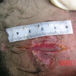 Dead young girl in forest