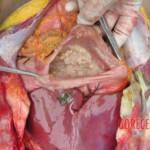 Dead young girl in forest