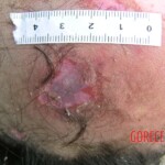 Dead young girl in forest