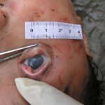 Dead young girl in forest