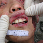 Dead young girl in forest