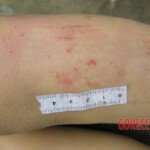 Dead young girl in forest