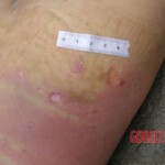 Dead young girl in forest