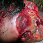 Dead young girl in forest