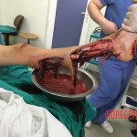 Destroyed leg