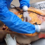 Autopsy of drowned woman