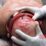 Autopsy of drowned woman