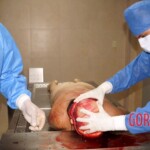 Autopsy of drowned woman