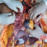 Autopsy of drowned woman