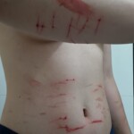 Self-harm on teen girl
