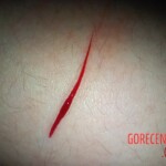 Self-harm on teen girl