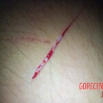 Self-harm on teen girl