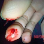 Self-harm on teen girl